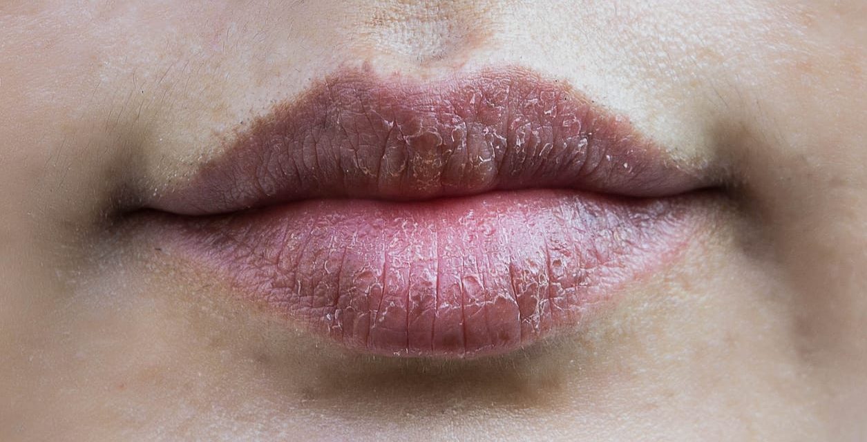 Penyebab Umum Bibir Kering Karena Cuaca Ekstrem Saat Ini