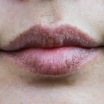 Penyebab Umum Bibir Kering Karena Cuaca Ekstrem Saat Ini