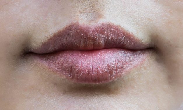 Penyebab Umum Bibir Kering Karena Cuaca Ekstrem Saat Ini