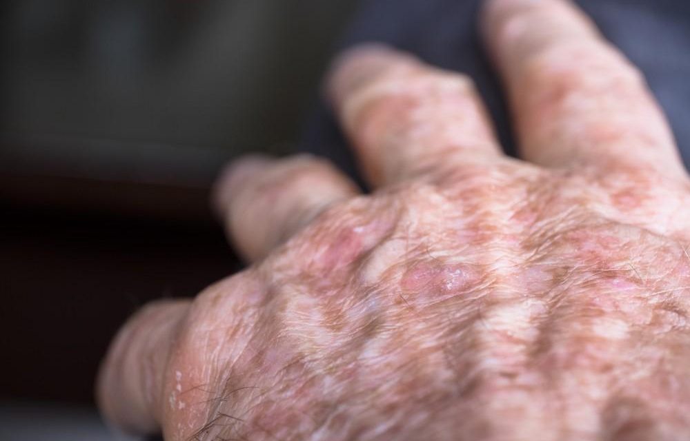 Actinic Keratosis, Penyakit Kulit Yang Sering Di Remehkan