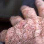 Actinic Keratosis, Penyakit Kulit Yang Sering Di Remehkan