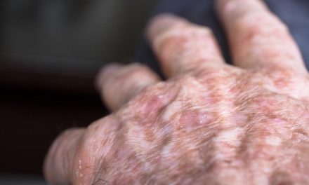 Actinic Keratosis, Penyakit Kulit Yang Sering Di Remehkan