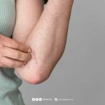 Penyakit Actinic Keratosis Kondisi Yang Sering Di Remehkan