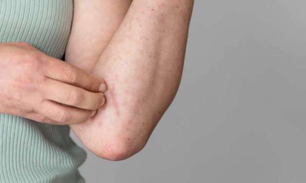 Penyakit Actinic Keratosis Kondisi Yang Sering Di Remehkan