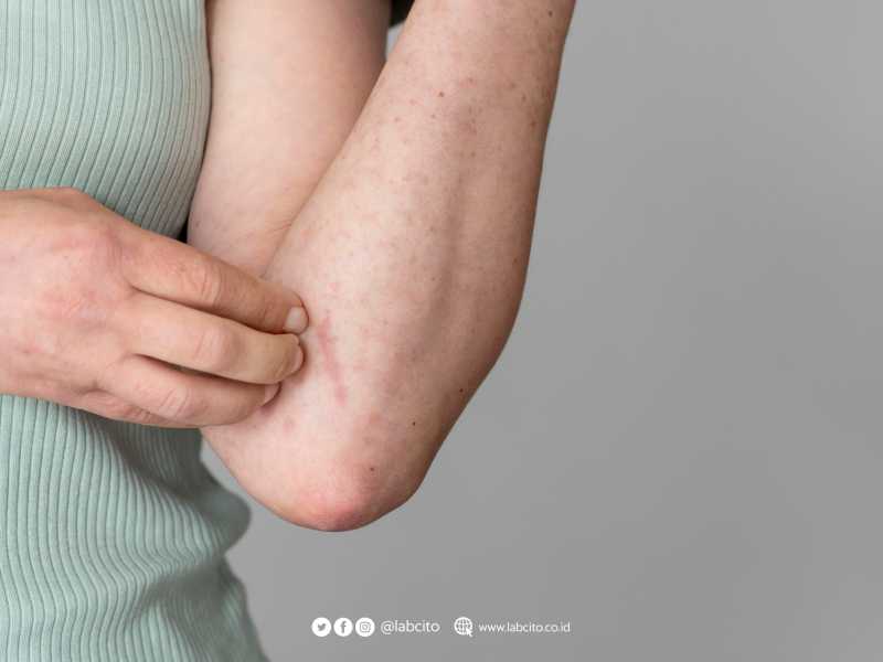 Penyakit Actinic Keratosis Kondisi Yang Sering Di Remehkan